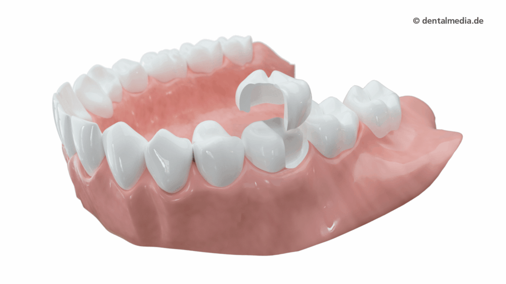 Teilkrone in Keramik