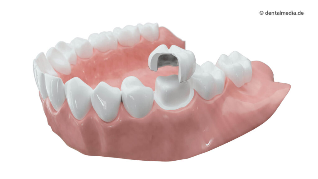 Vollkrone in Keramik - verblendet